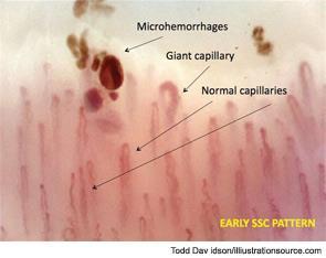Capillaroscopy a Safe and Direct Method for SSc