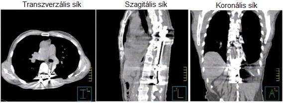 Az a besugarazott térfogat, amelyet a 95%-os izodózis görbe határol.iv: A teljes besugarazott térfogat. 2.3. ábra.