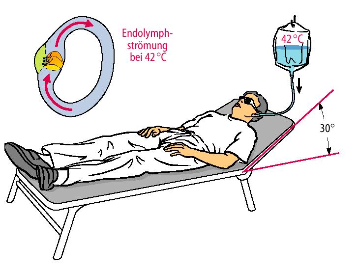 endolympha áramlást okoz Ewald-Flourens törvény: meleg inger - nystagmus az