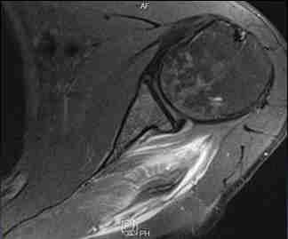 rectus femoris, quadriceps izomcsoport M. gastrocnemius M.