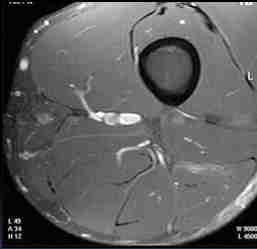 funkcionalis neuromuscularis sérülés Nincs képalkotó morfológia jele