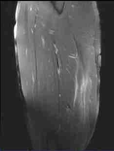 2013 BAMIC grading(british Athletics Muscle Injury Classification) -