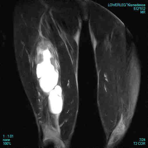 HAEMATOMA