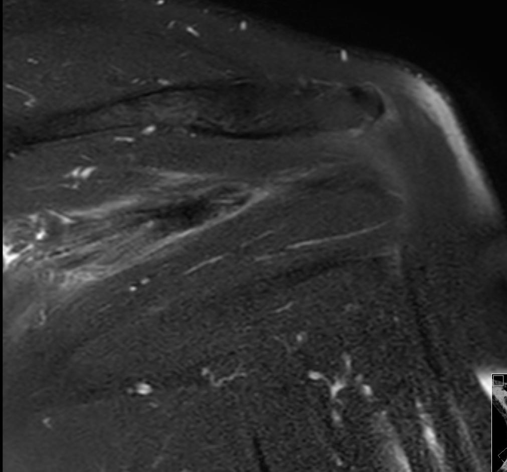 Calcificaló myonecrosis Izom hernia ( UH!