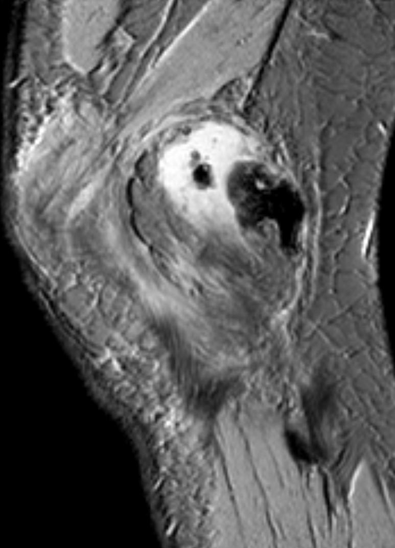 (DDG! parosteal osteosarcoma) Lamellaris,
