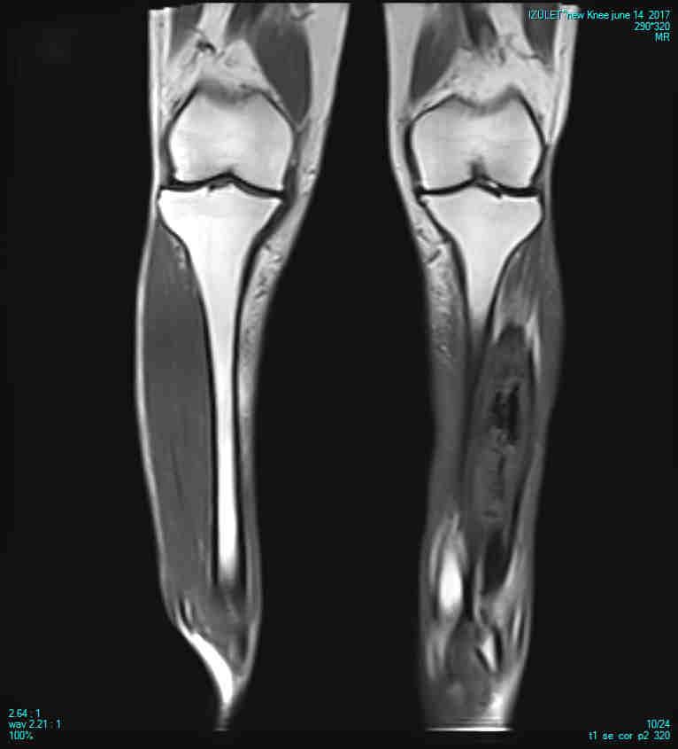 myositisek Infektiv myositis