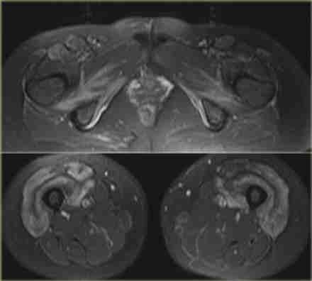 perifascialis folyadék +