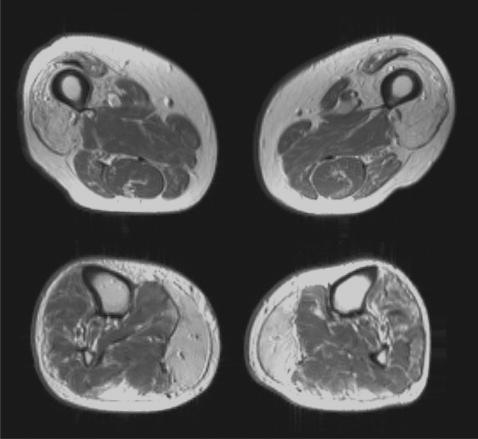 Polymyositis, dermatomyositis,