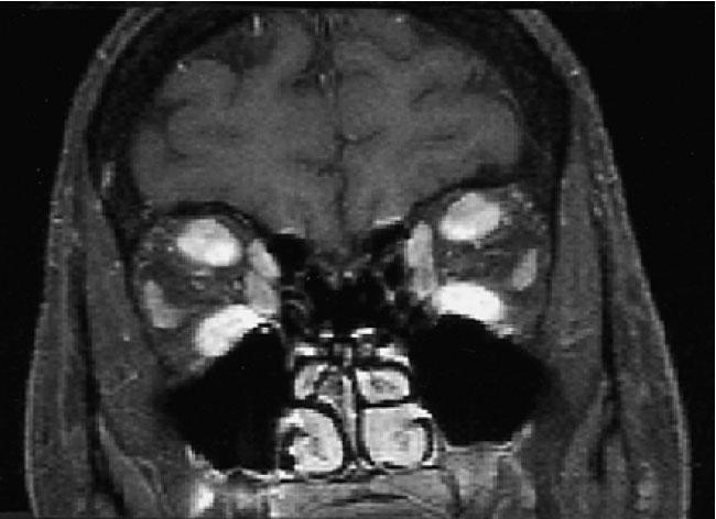 ZÁRVÁNYTESTES MYOSITIS ENDOKRIN