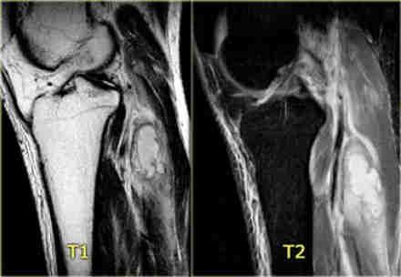 INFEKTIV MYOSITIS PYOMYOSITIS