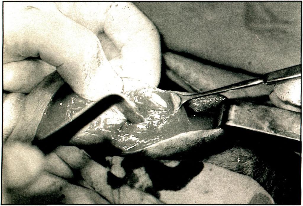 S U M M A R Y An unusual case of penile fracture (rupture of corpus cavernosum) that accidentally occurred during sexual intercourse is presented. The injury also involved the rupture of the urethra.