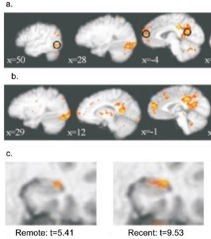 Occipito-temporalis: képek - Más hippocampalis régiók a távoli és közeli emlékeknél - A