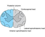 Brown Séquard szindróma: a gerincvelő féloldali károsodása Hátsó felszálló rendszer (fasciculus gracilis és cuneatus) Corticospinalis pálya Anterior és lateralis spinothalamicus pálya - A károsodás