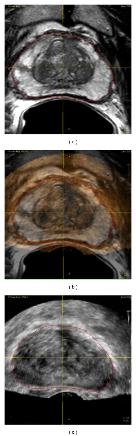 Prostate cancer diagnosis : multiparametric MR-targeted biopsy Magnetic with cognitive resonance and transrectal imaging/ US-MR ultrasound-fusion guidance versus biopsy systematic significantly