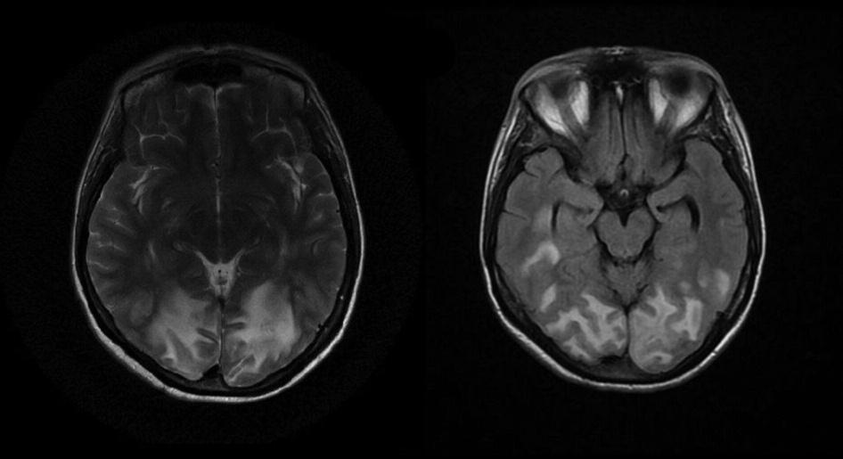 Case report A 35-year-old, right-handed woman presented to emergency department with a compressive headache spreading from neck to head and progressive fluctuating blurred vision for 5 days.