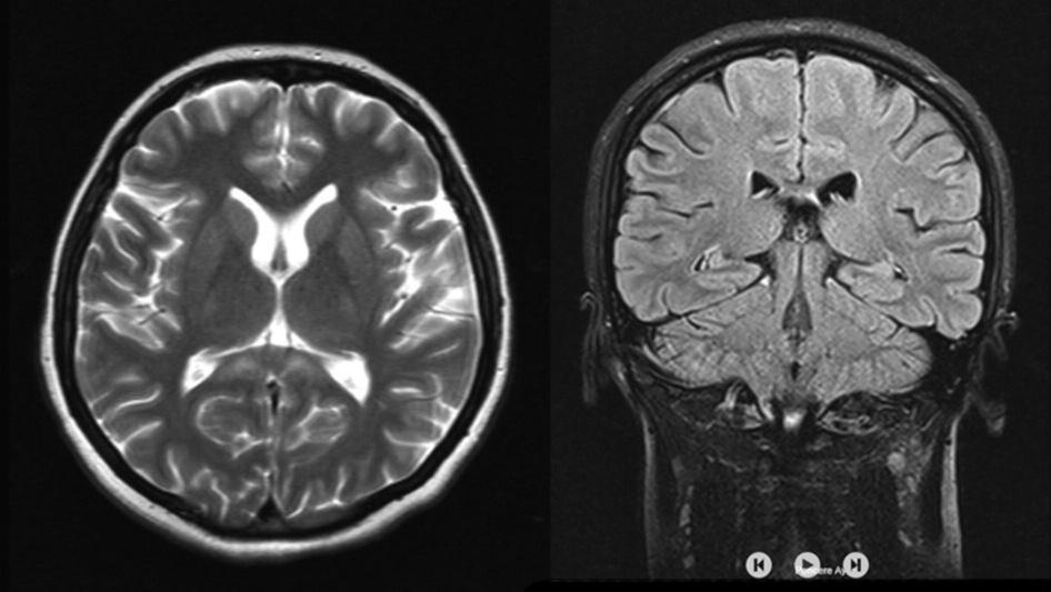 A Figure 2. A. Dramatic improvement in lesions of corpus callosum in T2 MRI. B.