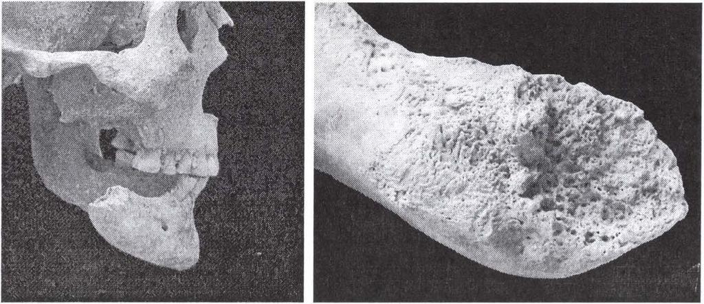 A csonthártya gyulladása (periostitis) leggyakrabban a sípcsontokon jelentkezett (jobb tibia 15,6%, bal tibia 10,3%), akárcsak a tiszafüredi bronzkori szériában, bár ott ennél lényegesen ritkábban
