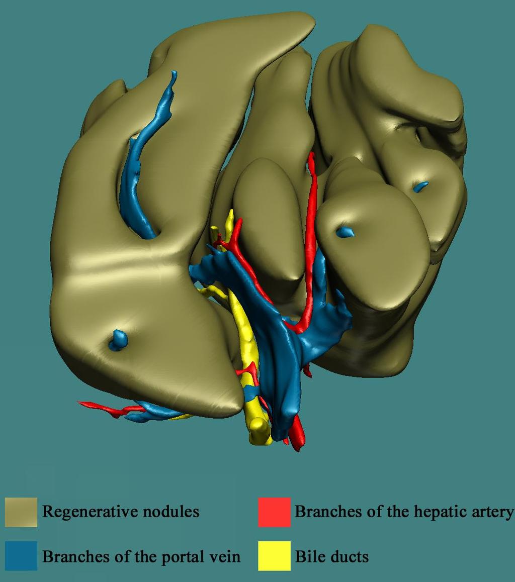 Cirrhosis -Előrehaladott A regeneratív nodulusok speciális szerkezete (portális véna a nodulus belsejében, az epeutak, artériák és centrális vénaágak a noduluson kívül a