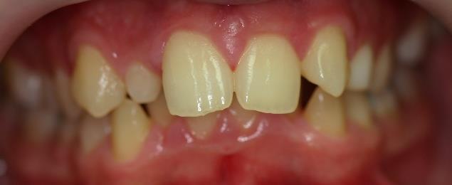 HYPODONTIA, APLASIA - HIÁNYZÓ FELSŐ KISMETSZŐK Az egyik leggyakoribb foghiány (5%) One of the most