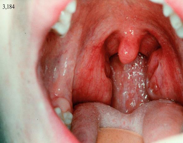 Pharyngitis chronica gyűjtőfogalom, különböző krónikus irritatív és gyulladásos állapotokra pharyngitis chr.