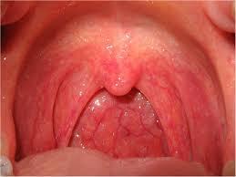 Vírusos Acut pharyngitis/tonsillopharyngitis leggyakoribb (70%) influenza, parainfluenza-, corona-, adeno-, rhino-,entero-, CMV vírus klinikum: változó kezdet enyhe erős torokfájás, nyelési