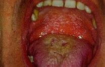 Gombás candidiasis (soor oris) immundeficiencia, antibiotikus terápia citosztatikum, irradiáció, kortikoszteroid Candida albicans klinikum: égő fájdalom, ízérzési zavar