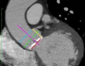 ascendens STJ sinus Sinus