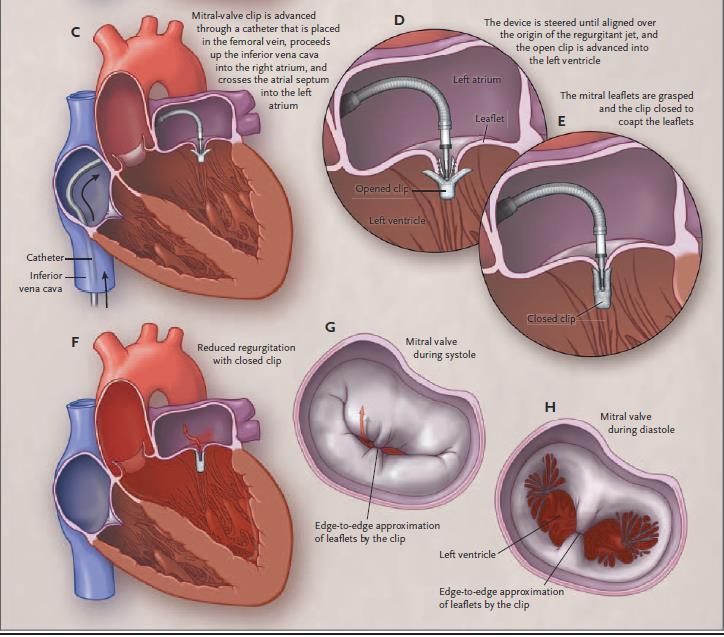 MitraClip NEJM