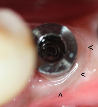 A peri-implantitis előfordulása interforaminálisan beültetett implantátumok esetén Megbeszélés, következtetés Szájhigiéné, keratinizált gingiva, csontminőség szerepe http://www.