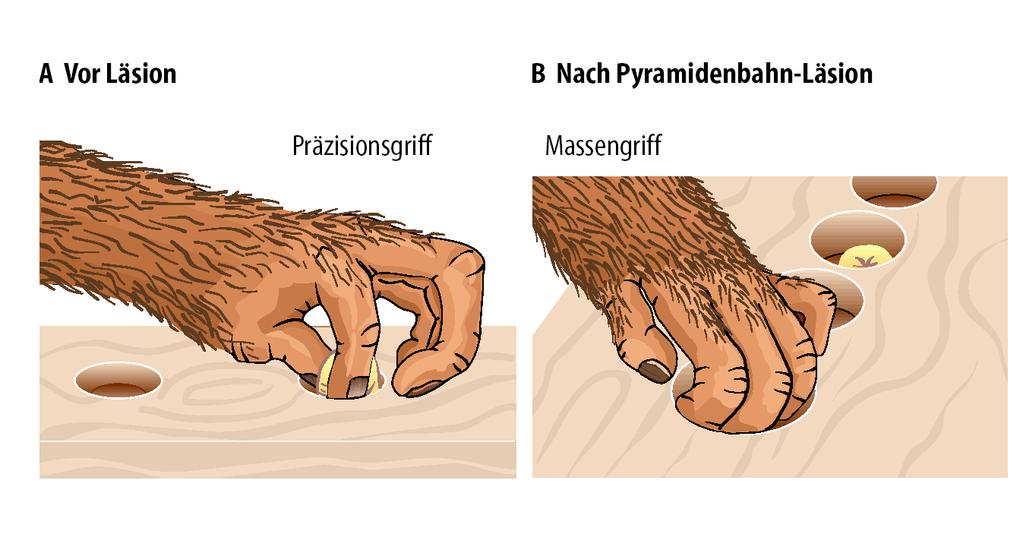 A pyramispálya (corticomotoneuronok) sérülése: - Finom célorientált mozgások kiesése (ujjak) - Babinski-jel (alsó végtag) - Kiterjedtebb