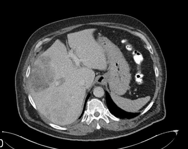 3. ábra Kontrasztanyagos CT embolizálás előtt(felső kép), ugyanaz a beteg 2 héttel később, embolizáció