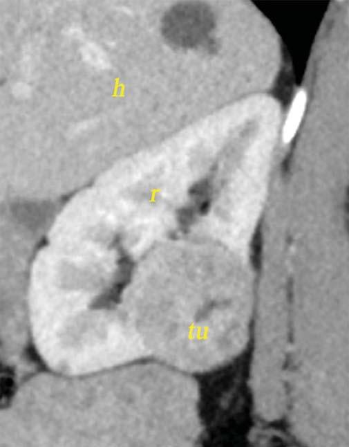 2. ÁBRA: A TUMOR KIMETSZÉSE ZÉRÓ ISZKÉMIÁ -BAN. A HILUS KÖRÉ BIZTOSÍTÓ HUROK KERÜLT, DE AZ NINCS MEG- SZORÍTVA.