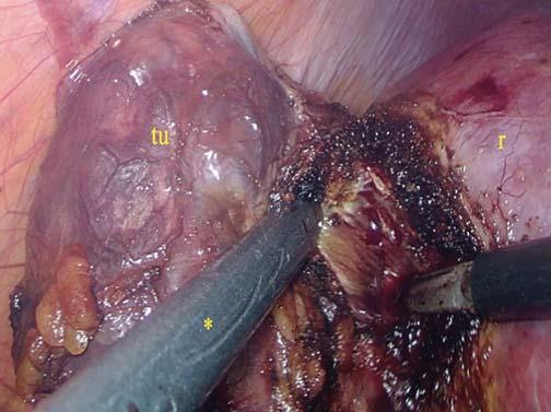 A TUMOR (TU) A VESE KÖZÉPSŐ HARMADÁBAN, A MEDIALIS LIMBUS- SZÉLEN HELYEZKEDIK EL, NAGYOBBRÉSZT ENDOPHYTICUS, ÁTMÉRŐJE 44 MM, A VESESINUST ELÉRI PADUA ÖSSZ- PONTSZÁM: 11.