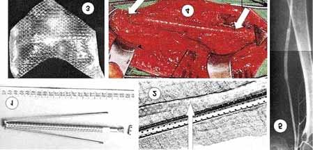 Flow: ml/ perc 7 Flow: 00 ml szövetre A módszert Fontányi hosszú éveken keresztül, több száz betegen eredményesen alkalmazta. Eljárásáról mintegy 50 közlés született.