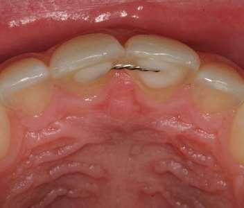Fix retainer diasthema