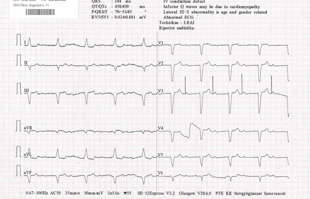 2. EKG Hosszabb ritmuscsík általában tartós vezetési zavarnál egyértelmű diagnózist ad, de vannak buktatók Esetismertetés: 77 éves nő beteg 6 hónapja gyenge, fáradékony, 10 lépést