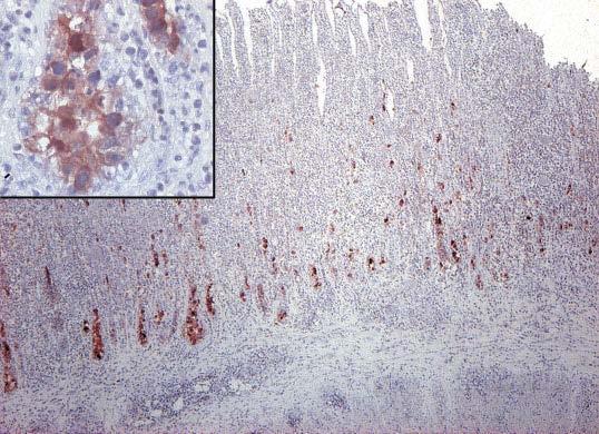Kórhatározás A FAdV okozta zúzógyomorgyulladás-kimaródásfekély kórkép kórhatározása: Keratinoid réteg makroszkópikus elváltozása; Szövettanilag tipikus bazofil magzárványok a mirigyhám sejtekbe; A