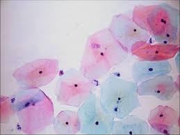 érmegbetegedések (érgyulladás, thrombozis) Fehérvérsejtek: Kóros ha a vizeletben látóterenként 4-6 fehér vértestnél több látható.