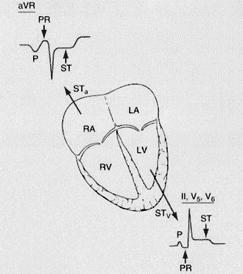 Pericarditis Jellemzői: Az ST-elevációeleváci mértéke ritkán n nagyobb 5 mm-nél; Konkáv v alakú STE; A diffúz z forma nem respektálja a koronáriákriák ellátási területét, t, típusosan avr és s V1