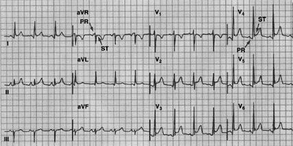 Pericarditis