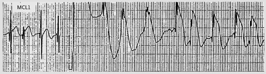 DC Cardioversio V1 V2 V3 V4 V5 V6 n=146 Afib vagy Aflut beteg transthoracic DC cardioversio; ; 23 (16 %) esetben > 5 m STe EKG normalizálódott 1.