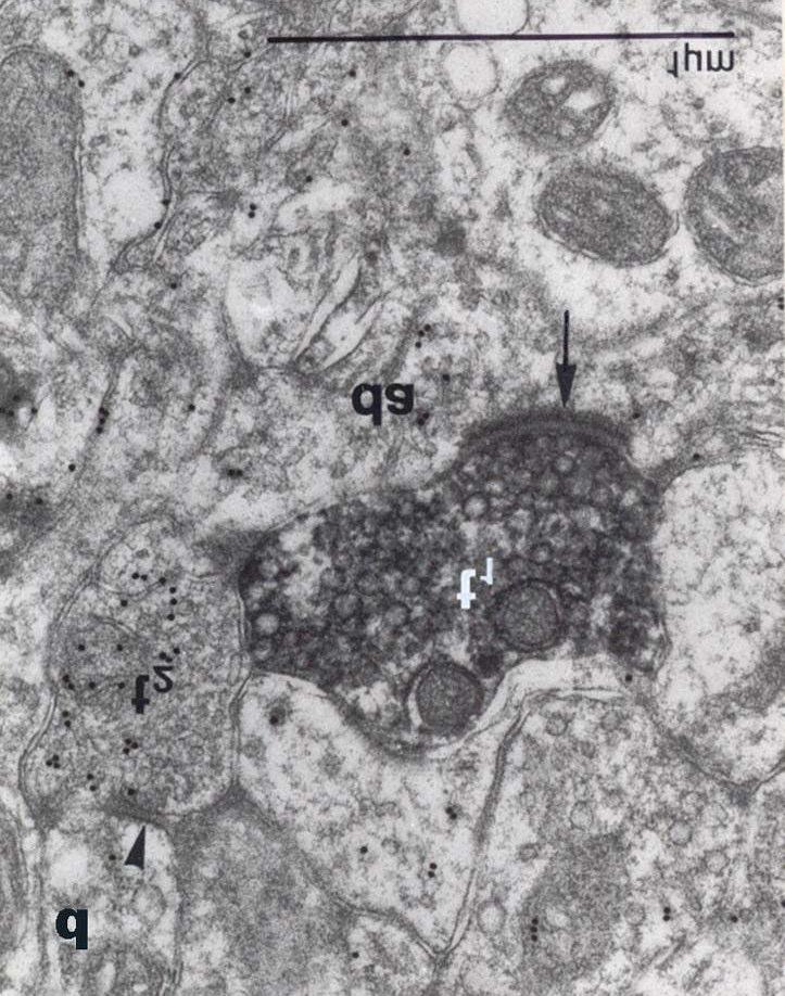 28. ábra: A nlmmc elektronmikroszkópos felvételén BDA-val jelölt opticus terminális (t 1 ) aszimmetrikus synapsist (Î) képez egy