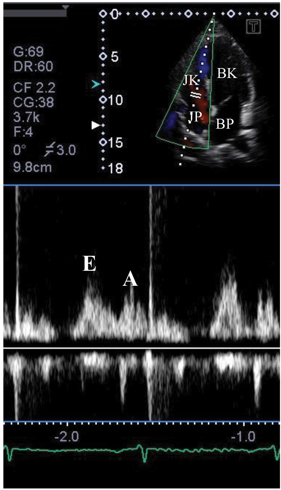 JP-i szabad (anterolateralis) fal és az interatrialis septum között arra merőleges irányban BK = bal kamra; BP = bal pitvar; JK = jobb karma; JP = jobb pitvar 3.