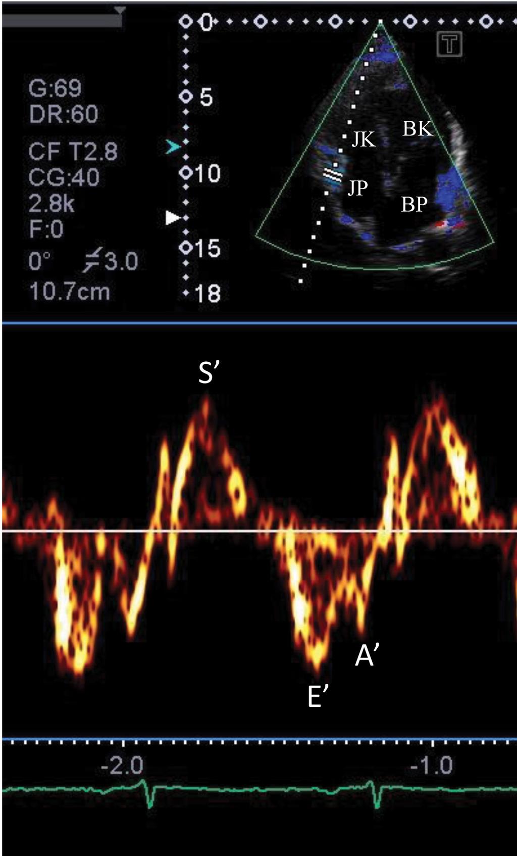 A szisztolés longitudinális sebesség (S ) mellett korai (E ) és késői (A ) diasztolés myocardialis sebességértékeket tudunk mérni BK = bal kamra; BP = bal pitvar; JK = jobb kamra; JP = jobb pitvar