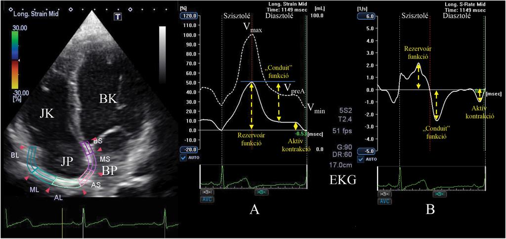 4. ábra Kétdimenziós speckle-tracking echokardiográfia során a kétdimenziós apicalis 4 üregi felvételen a globális longitudinális strain (folyamatos fehér vonal) (A) és strain rate (B), valamint a