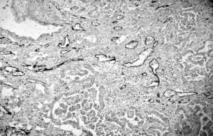 1. táblázat. A két klinika beteganyagának összehasonlítása Bevezetés A tüdôcarcinoma prognózisának meghatározását ma rutinszerûen a TNM rendszer alapján végezük.