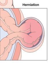 Hernia Volvulus Intussusceptio 80 %