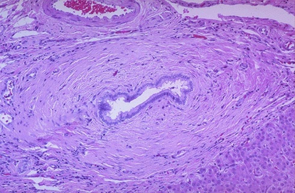 Cholestaticus májbetegségek (PBC,PSC) PRIMER