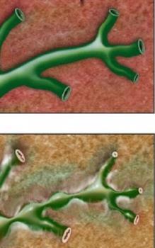 Cholestaticus májbetegségek (PBC,PSC) PRIMER