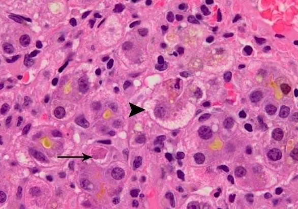 Akut és krónikus hepatitisek Akut hepatitis Akut lobularis hepatitis Makró: eltérés nélkül/tarka rajzolat/megnagyobbodott